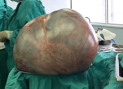 Ethiopia Health : Doctors Remove 30 kg Ovarian Tumor From A Woman